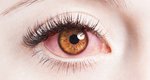 Κοκκινίζουν τα μάτια σου; Τι μπορεί να προκαλεί το σύμπτωμα και πώς να το αντιμετωπίσεις